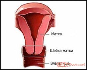 Воспаление влагалища: лечение, симптомы, причины