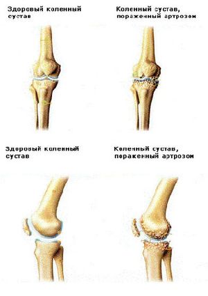 Почему хрустят суставы у ребенка